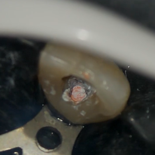 孙宇老师 教你用八颗牙热牙完成连续波充填
